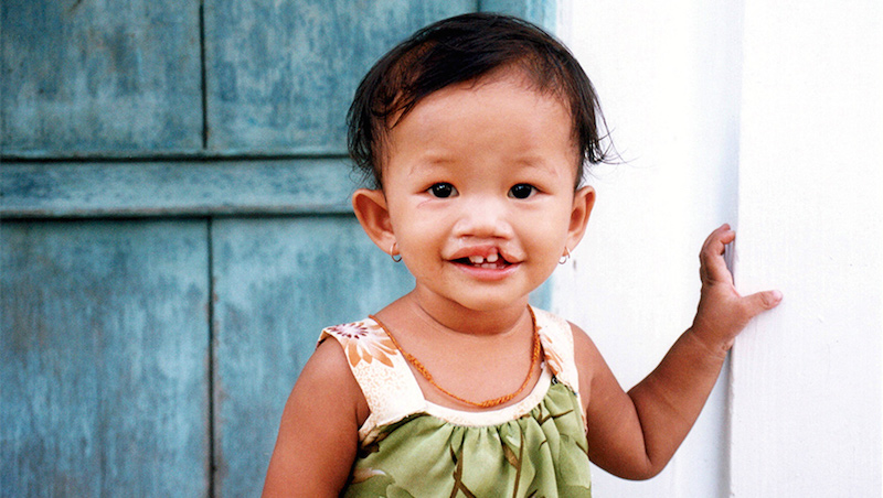 Giving Tuesday: Donations will be matched for Operation Smile
